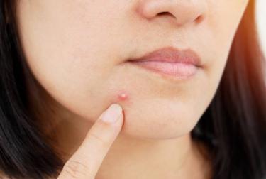 Are you worried about acne?